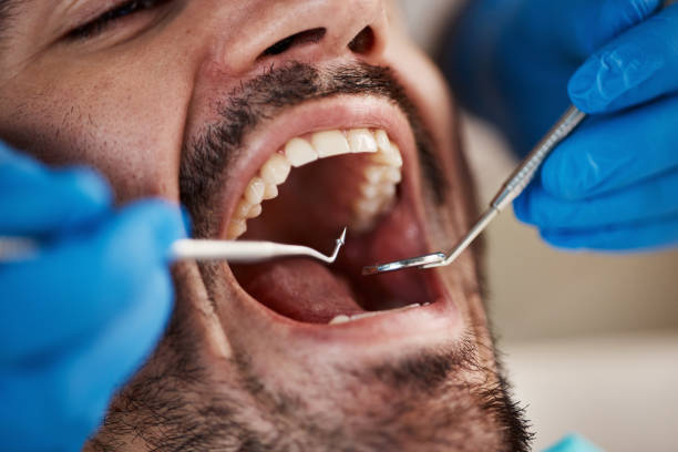 Best Emergency Treatment for Oral Infections in Odon, IN