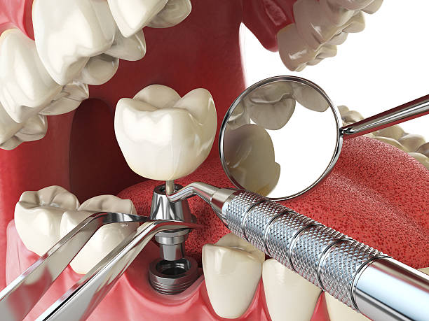 Best Emergency Root Canal Therapy in Odon, IN